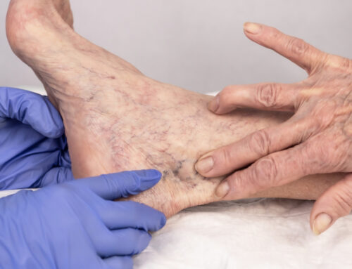 Understanding Sclerotherapy: A Comprehensive Guide